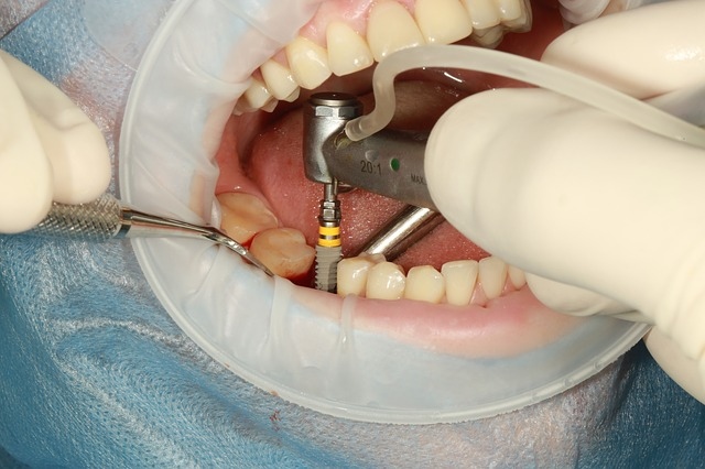 zobni implantati cena